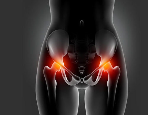 Hip Replacement Surgery